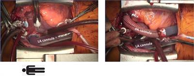 Case report: Paracorporeal lung assist device for 215 days as a bridge-to-lung transplantation in a patient with bronchopulmonary dysplasia and severe pulmonary hypertension
